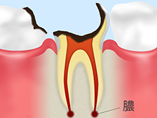 C4：歯根まで達した虫歯