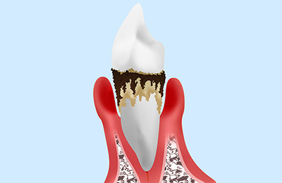 歯周病の悪影響は全身にもおよぶことがあります