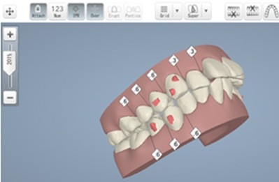 メリット5：歯の動きをシミュレーションできる